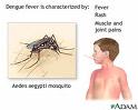 Figura dengue, dor de cabeça, cefaleia, mosquito, rash